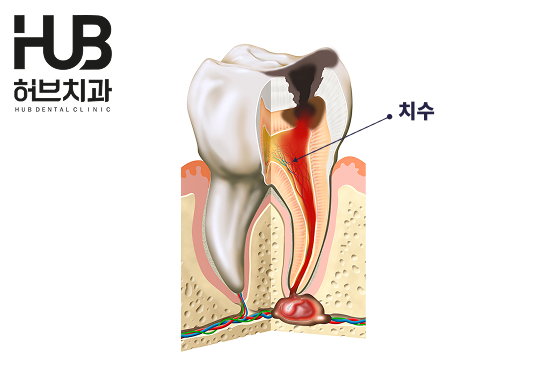 아산충치치료, 단 음식 먹을 때 찌릿한 통증 왜 생길까요? - 4
