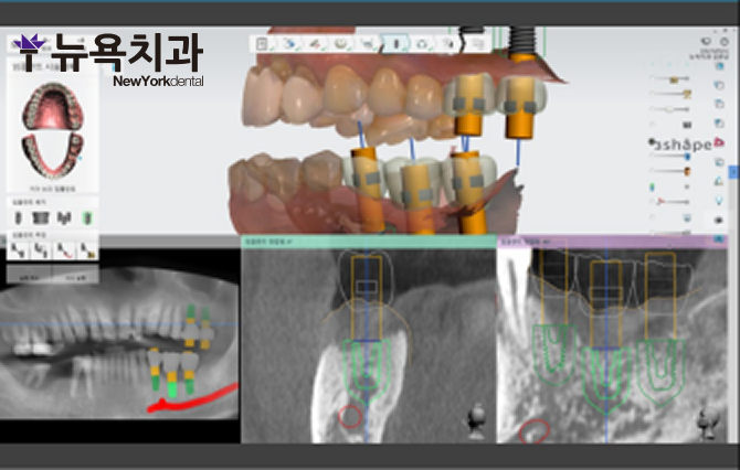구월동 어금니 임플란트, 왼쪽 위아래 어금니를 함께 회복한 사례 - 3