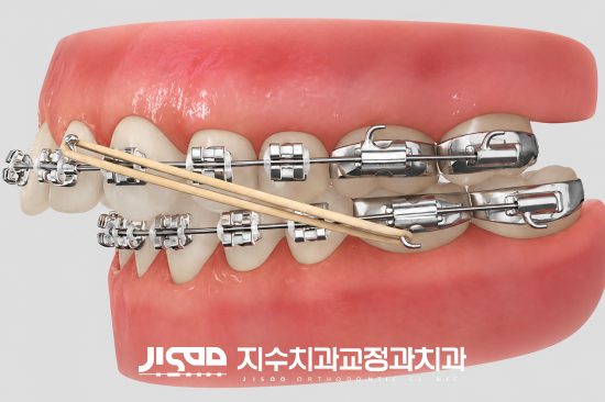 반월당교정치과에서 설명해 드리는 교정 중 고무줄 착용이 중요한 이유 - 2