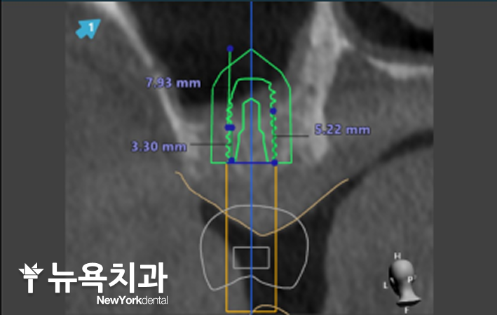 구월동 상악동 거상술 임플란트로 왼쪽 위 어금니 기능을 회복한 사례 - 2