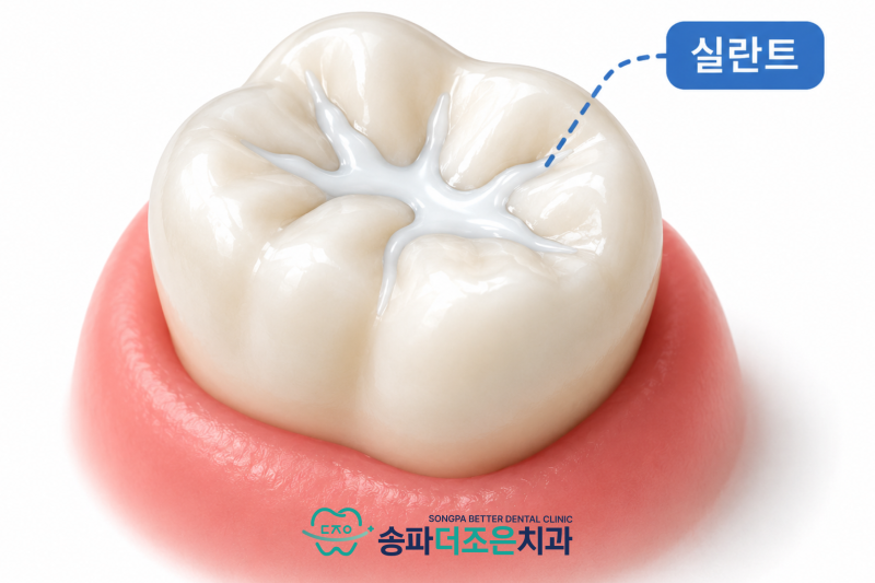송파 어린이 치과, 충치 예방을 위한 실란트(홈메우기) 영구치가 올라오는 시기에 확인해야 하는 이유 - 1