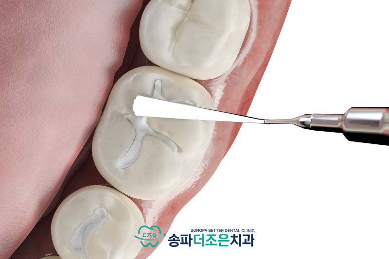 송파 어린이 치과, 충치 예방을 위한 실란트(홈메우기) 영구치가 올라오는 시기에 확인해야 하는 이유 - 3