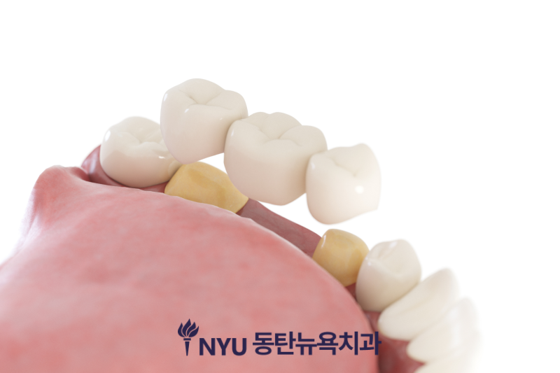 동탄역 치과 치아가 빠졌을 때 브릿지 치료가 필요한 경우는?