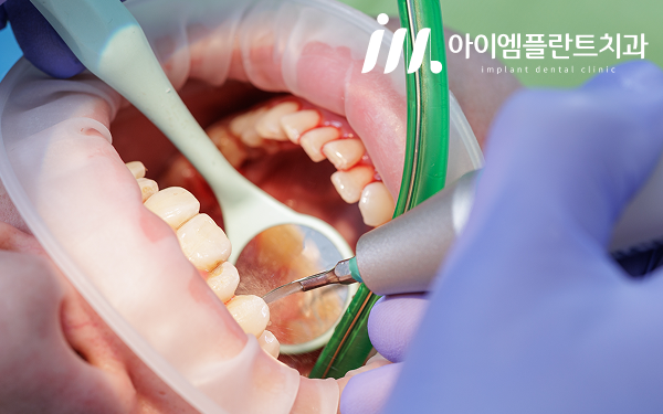 안산 치주염 치료, 스케일링만으로는 충분하지 않은 이유