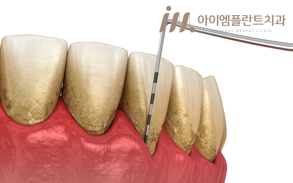 안산 치주염 치료, 스케일링만으로는 충분하지 않은 이유 - 2