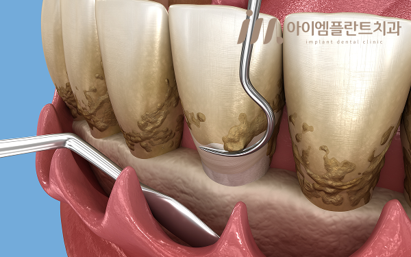 안산 치주염 치료, 스케일링만으로는 충분하지 않은 이유 - 3