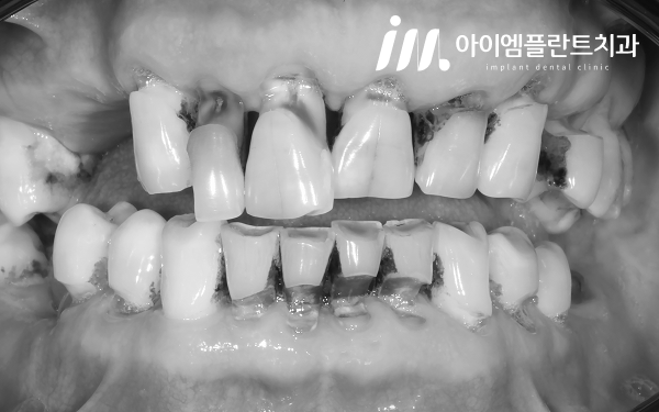 안산 치주염 치료, 스케일링만으로는 충분하지 않은 이유 - 4