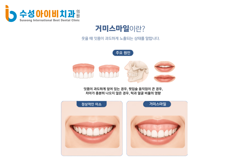 대구잇몸성형, 잇몸이 과도하게 보이는 거미스마일 치료 자연스러운 미소를 위해 먼저 확인하는 것