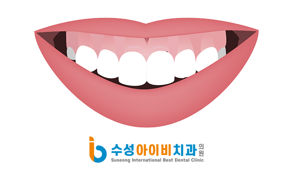 대구 거미스마일 비용, 치은 절제술은 얼마나 들까?