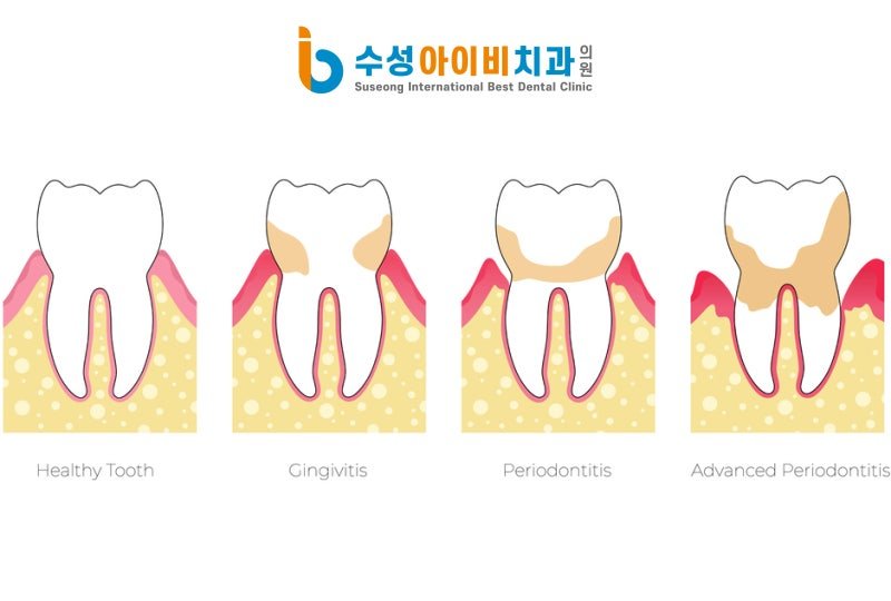 수성 잇몸치료 잘 하는 치과, 염증 깊이에 따른 단계별 치료 방법 - 1