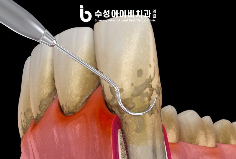 수성 잇몸치료 잘 하는 치과, 염증 깊이에 따른 단계별 치료 방법