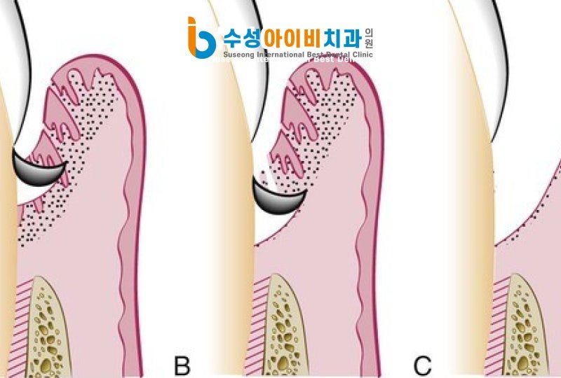 수성 잇몸치료 잘 하는 치과, 염증 깊이에 따른 단계별 치료 방법 - 3