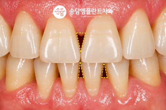 안중읍치과, 스케일링을 하면 치아가 깎인다는 말 사실일까요? - 2