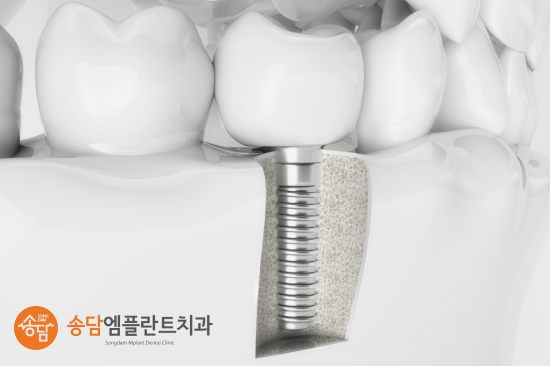 안중 임플란트 비용 보다 중요하게 확인해야 할 부분이 있습니다 - 1