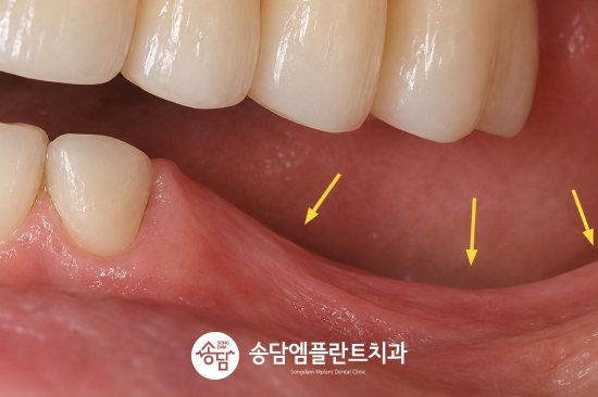 안중 임플란트, 잇몸뼈 이식은 어떤 경우에 필요할까요?