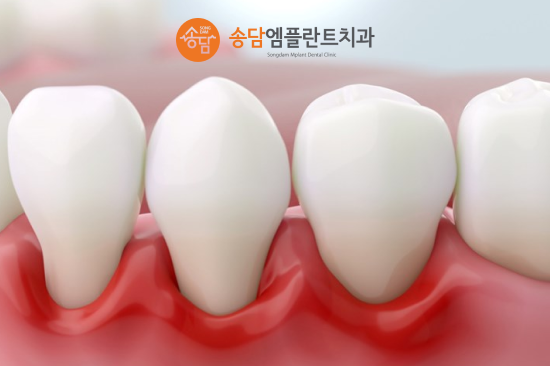 안중 임플란트, 잇몸뼈 이식은 어떤 경우에 필요할까요? - 2