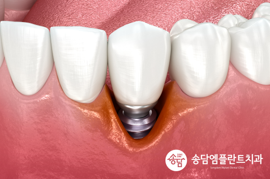 안중 임플란트 비용 보다 중요하게 확인해야 할 부분이 있습니다 - 4