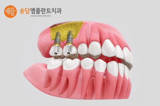안중 임플란트, 잇몸뼈 이식은 어떤 경우에 필요할까요? - 3