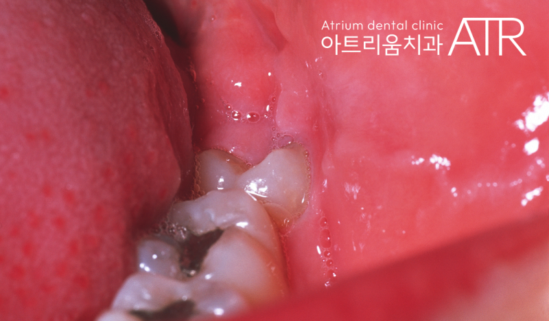 평택 사랑니 치과, 안 아프게 잘 뽑아주는 곳 없을까 고민 중이시라면? - 3
