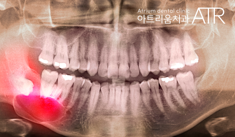 평택 사랑니 치과, 안 아프게 잘 뽑아주는 곳 없을까 고민 중이시라면? - 4
