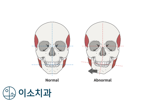 오산 안면비대칭, 치아교정만으로 가능할까? - 1