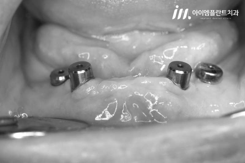 안산 고잔역 임플란트 잘하는 곳, 임플란트 틀니가 궁금하시다면 - 4