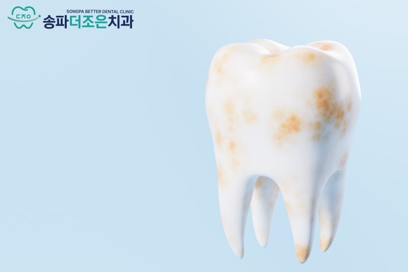 잠실역 치아미백 치과, 치아미백 전에 스케일링을 권하는 이유 - 1