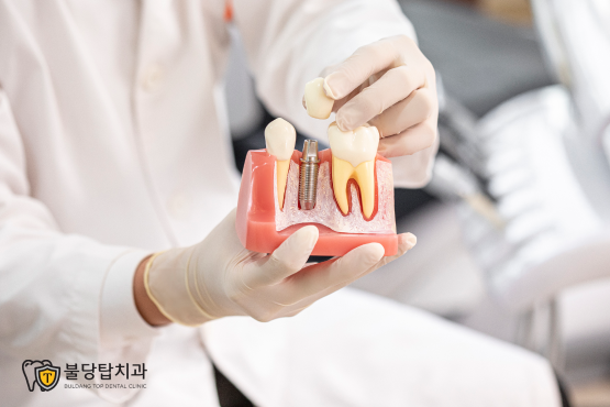천안 불당2동 뼈이식 임플란트 치과, 어떤 경우 필요할까요? - 7
