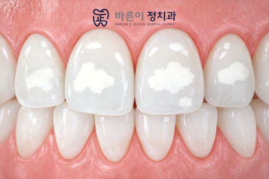 상계동 충치예방, 성인도 불소도포를 받을 필요가 있을까요? - 2