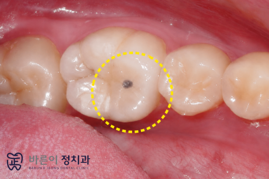 상계동 충치예방, 성인도 불소도포를 받을 필요가 있을까요? - 3