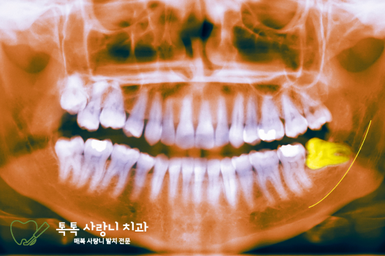대구사랑니치과, 발치 전 가장 많이 물어보는 질문 정리해 드립니다 - 2