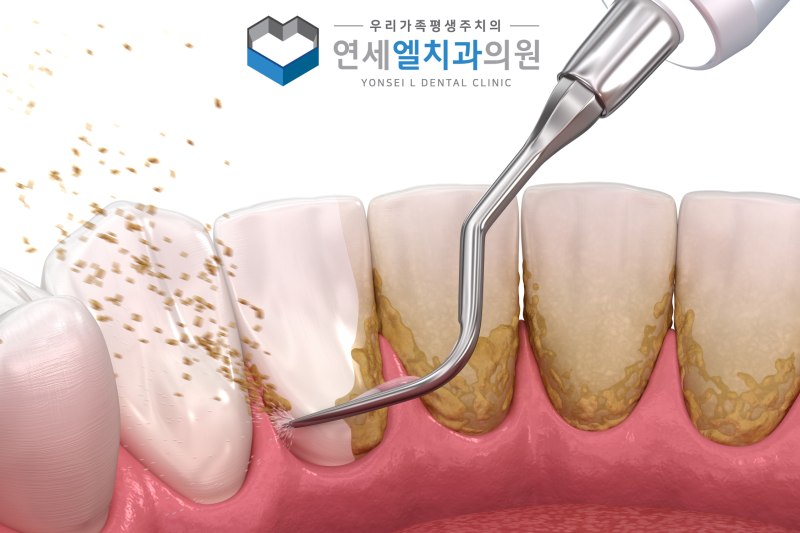 행신동 잇몸치료, 스케일링과 차이를 알아야 하는 이유 - 1