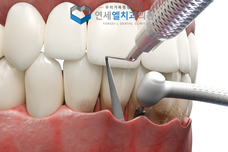 행신동 잇몸치료, 스케일링과 차이를 알아야 하는 이유 - 3