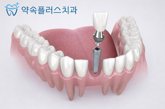 지제역 임플란트 저렴한 곳보다는 '이런 기준'으로 살펴보세요 - 3