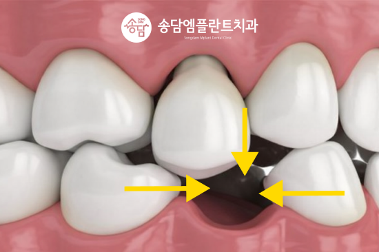 화양지구 임플란트, 치아를 잃은 뒤 치료 시기가 중요한 이유 - 1