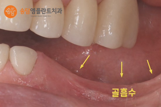 화양지구 임플란트, 치아를 잃은 뒤 치료 시기가 중요한 이유 - 2