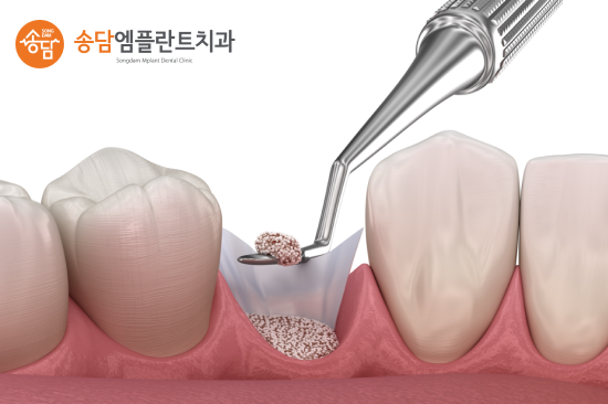 화양지구 임플란트, 치아를 잃은 뒤 치료 시기가 중요한 이유 - 3