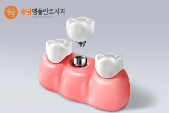 화양지구 임플란트, 치아를 잃은 뒤 치료 시기가 중요한 이유
