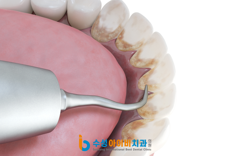 수성구 잇몸치료와 스케일링 차이 정확히 알고 계시나요?