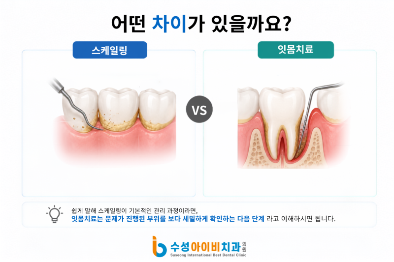 수성구 잇몸치료와 스케일링 차이 정확히 알고 계시나요? - 2