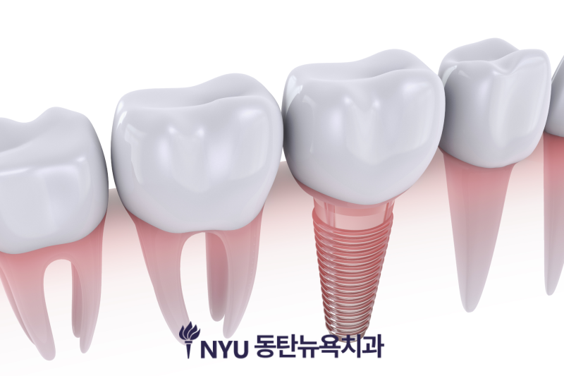 동탄 임플란트 잘하는 치과 찾는다면, 보증제도와 책임 진료까지 확인하세요 - 1