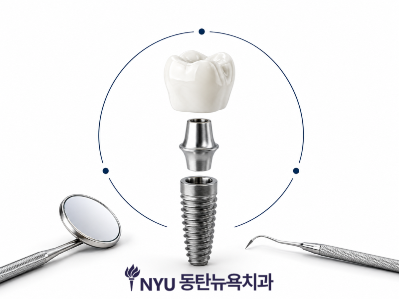 동탄 임플란트 잘하는 치과 찾는다면, 보증제도와 책임 진료까지 확인하세요 - 3