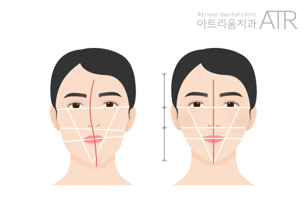 평택 안면비대칭, 치아교정만으로 개선될 수 있을까요?