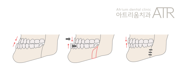 평택 안면비대칭, 치아교정만으로 개선될 수 있을까요? - 3