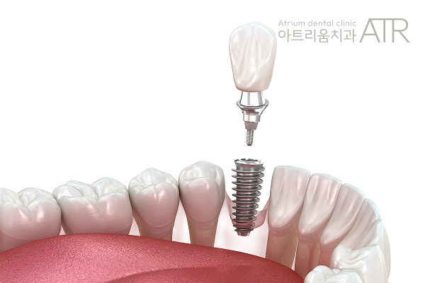 평택 임플란트 싼 곳에서 치료받아도 괜찮을까요? - 1