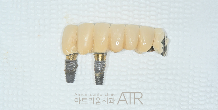 평택 임플란트 싼 곳에서 치료받아도 괜찮을까요? - 4