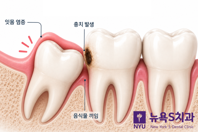 종로 매복사랑니 발치, 어금니 뒤쪽 통증이 반복된다면 - 2