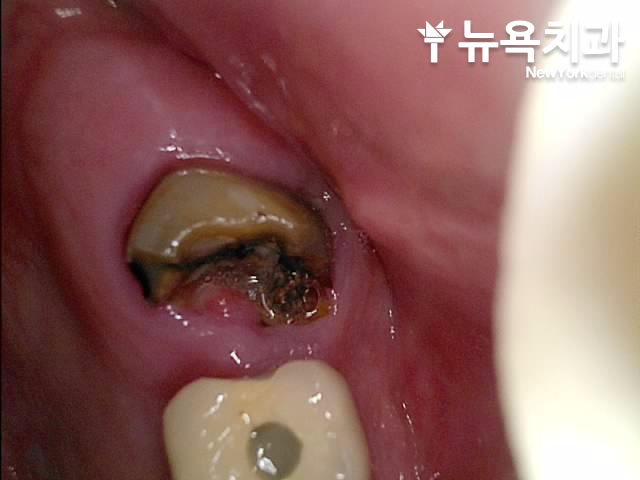 구월동 뿌리만 남은 치아, 발치 후 임플란트로 회복한 사례