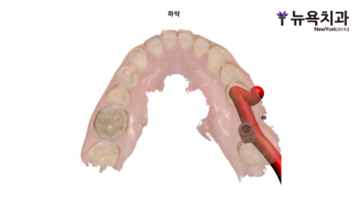 구월동 뿌리만 남은 치아, 발치 후 임플란트로 회복한 사례 - 2