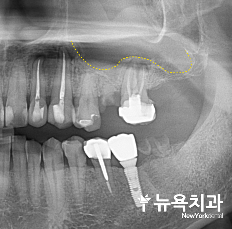 구월동 뿌리만 남은 치아, 발치 후 임플란트로 회복한 사례 - 3